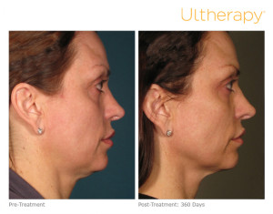 ultherapy_beforeandafter_fullface_1_roseville_ca