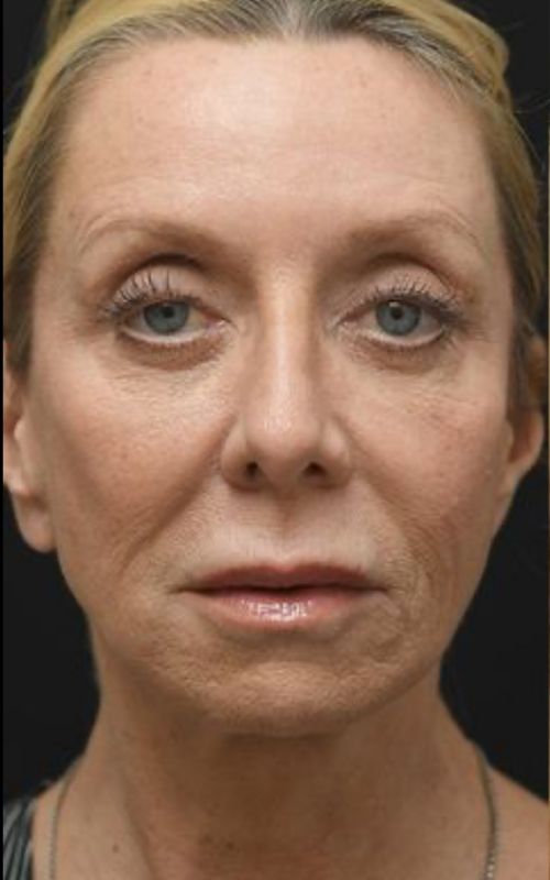 fatinjectionsliplifttcapeelfaceliftnecklift2342 Roseville