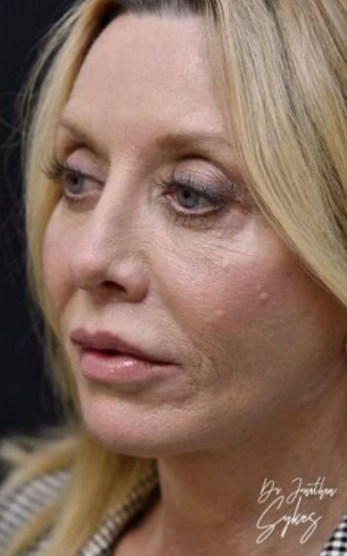 fatinjectionsliplifttcapeelfaceliftnecklift2348 Roseville