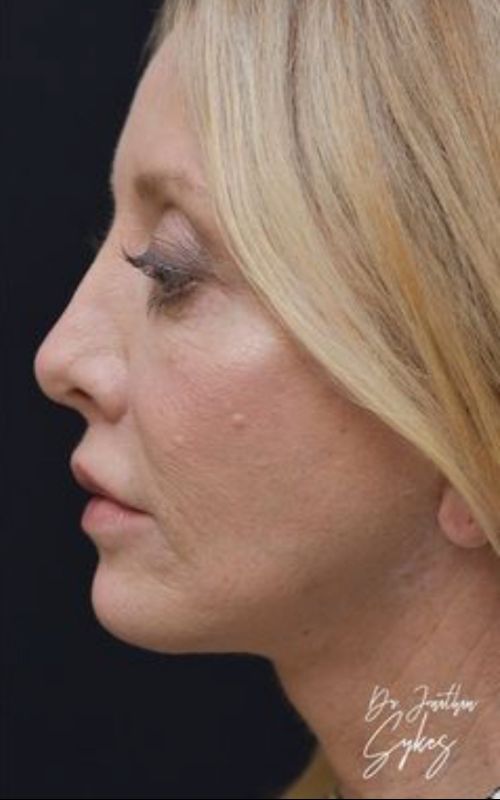 fatinjectionsliplifttcapeelfaceliftnecklift2349 Roseville