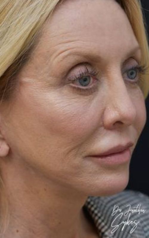 fatinjectionsliplifttcapeelfaceliftnecklift2350 Roseville