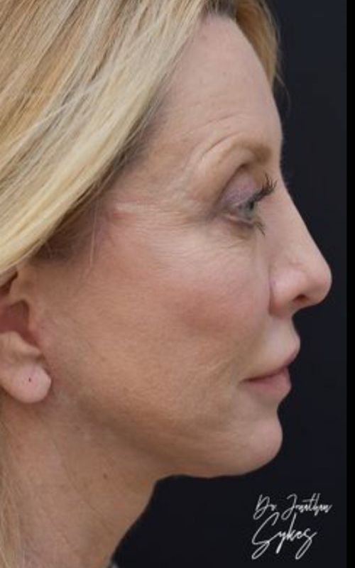 fatinjectionsliplifttcapeelfaceliftnecklift2351 Roseville